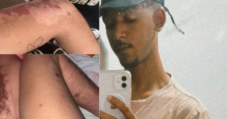 apos-9-meses,-jovem-conta-como-teve-corpo-incendiado-pelo-marido-na-bahia-e-acusa-tentativa-de-feminicidio