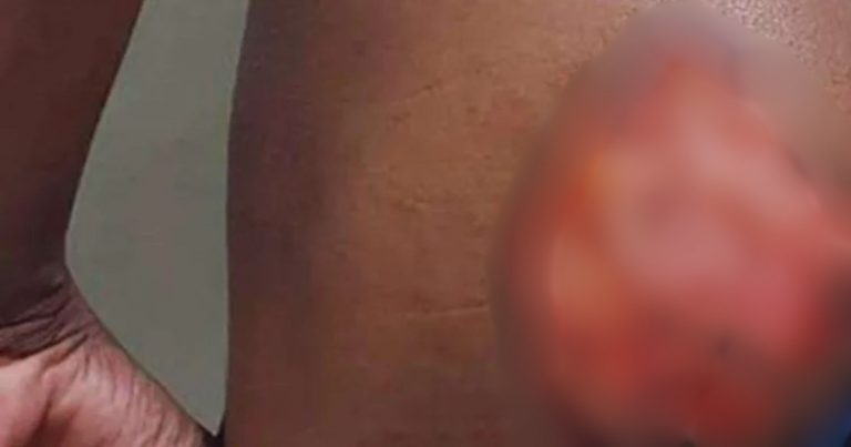 jovem-negro-com-deficiencia-auditiva-e-marcado-por-ferro-no-sudoeste-baiano;-irmaos-sao-presos